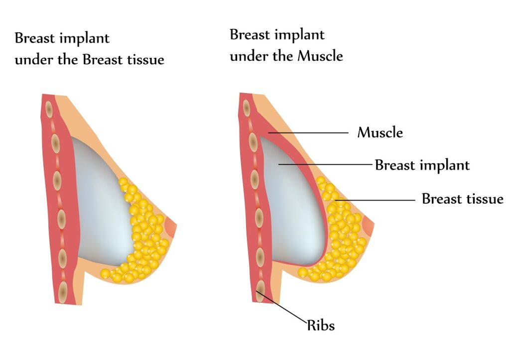 Breast Lift Vs Breast Implants: Understanding the Differences