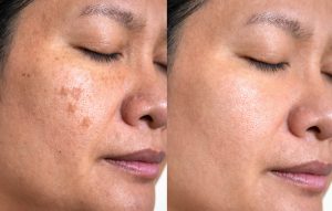 Medical Spa Treatment Before & After  in SACRAMENTO & GRANITE BAY, CA